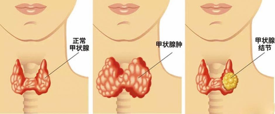 甲狀腺結節(jié)